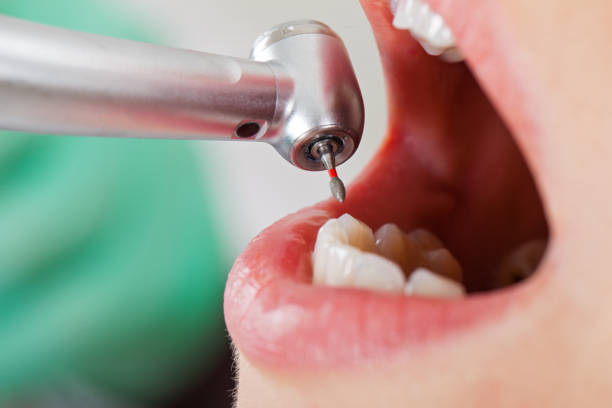 Best Emergency Dental Care for Broken or Chipped Teeth in Millington, NJ
